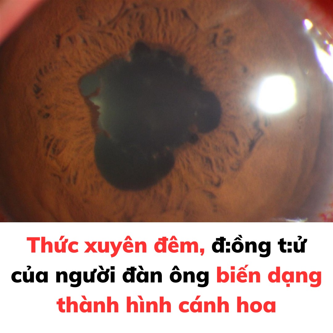 Thức xuyên đêm, đ:ồng tử của người đàn ông biến dạng thành hình cánh hoa