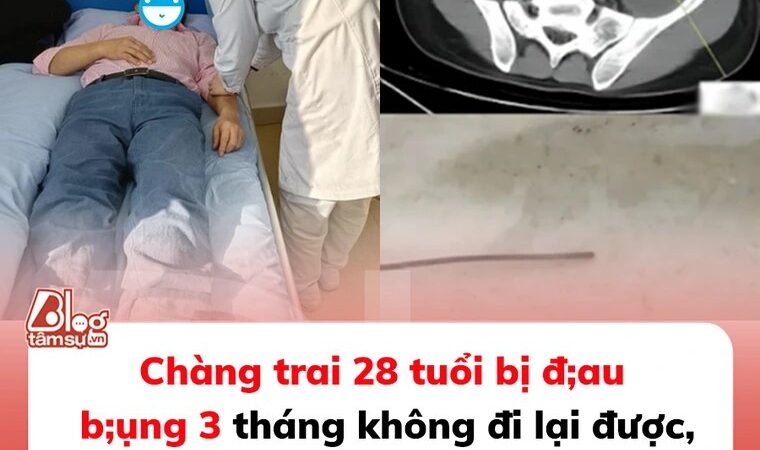 Chàng trai 28 tuổi bị đau bụng 3 tháng không đi lại được, đến viện bác sĩ ‘lôi ra’ thứ dài 13cm trong bụng