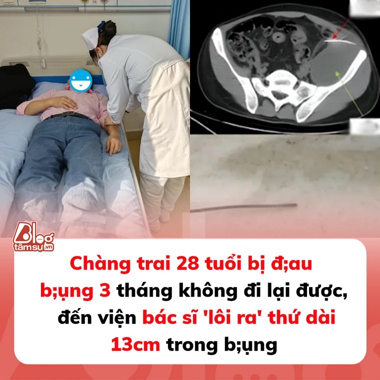 Chàng trai 28 tuổi bị đau bụng 3 tháng không đi lại được, đến viện bác sĩ ‘lôi ra’ thứ dài 13cm trong bụng