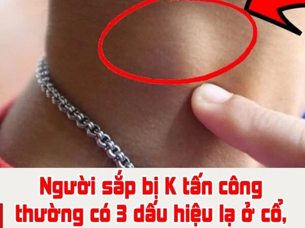 Người sắp bị K tấn công thường có 3 dấu hiệu lạ ở cổ, số 1 nguy hiểm nhất